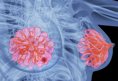 新型免疫疗法或能让乳腺癌患者的癌症全面消退